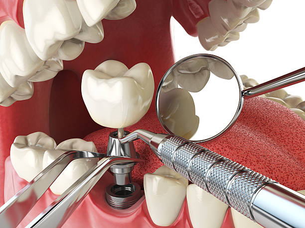 Best Dental Abscess Treatment in Decatur, TX